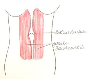 Rektusdiastase Übungen